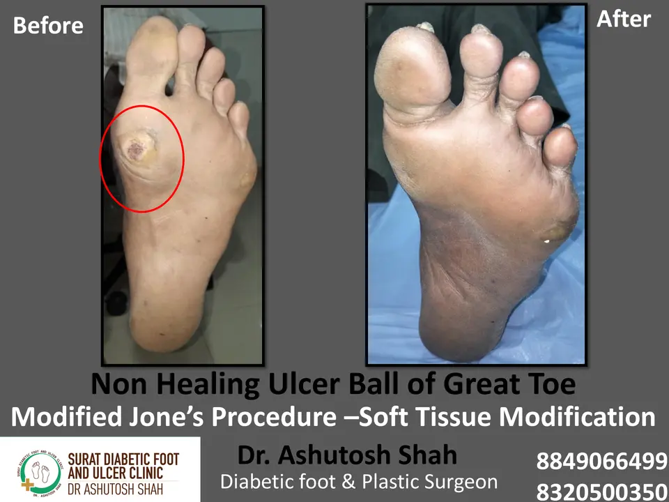 Diabetic Foot  PPT 3 checked by sir.pptx-71.webp